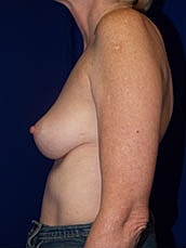 Breast Augmentation Before & After