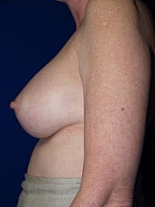 Breast Augmentation Before & After
