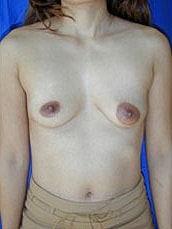 Breast Augmentation Before & After