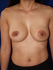 Breast Augmentation Before & After