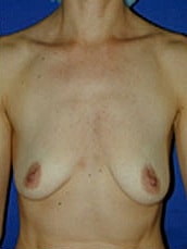 Breast Augmentation Before & After