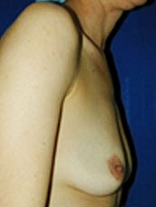 Breast Augmentation Before & After