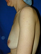 Breast Augmentation Before & After