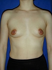 Breast Augmentation Before & After
