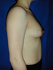 Breast Augmentation Before & After