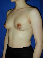 Breast Augmentation Before & After