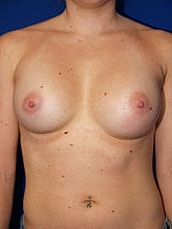 Breast Augmentation Before & After