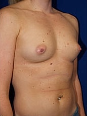 Breast Augmentation Before & After