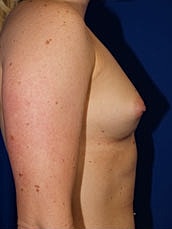 Breast Augmentation Before & After
