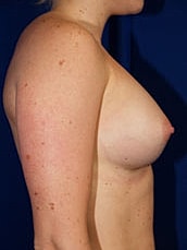 Breast Augmentation Before & After