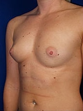 Breast Augmentation Before & After