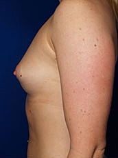 Breast Augmentation Before & After