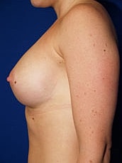 Breast Augmentation Before & After