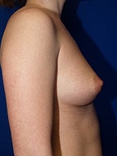 Breast Augmentation Before & After