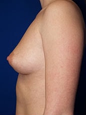 Breast Augmentation Before & After