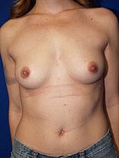 Breast Augmentation Before & After