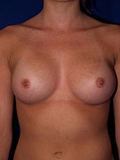 Breast Augmentation Before & After