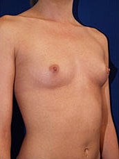 Breast Augmentation Before & After