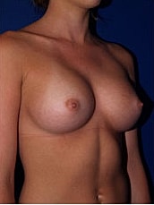 Breast Augmentation Before & After