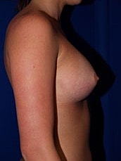 Breast Augmentation Before & After