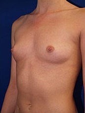 Breast Augmentation Before & After