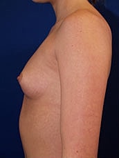 Breast Augmentation Before & After