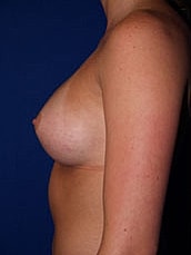 Breast Augmentation Before & After