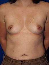 Breast Augmentation Before & After