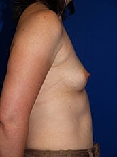 Breast Augmentation Before & After