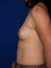 Breast Augmentation Before & After