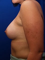 Breast Augmentation Before & After