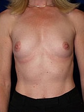 Breast Augmentation Before & After