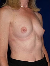 Breast Augmentation Before & After