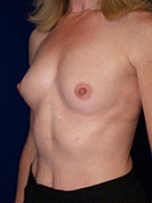 Breast Augmentation Before & After