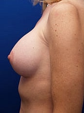 Breast Augmentation Before & After