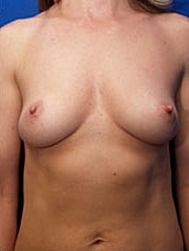 Breast Augmentation Before & After