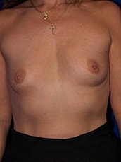Breast Augmentation Before & After
