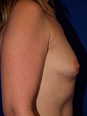Breast Augmentation Before & After