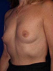 Breast Augmentation Before & After