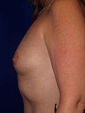 Breast Augmentation Before & After