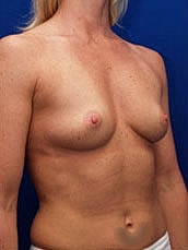 Breast Augmentation Before & After