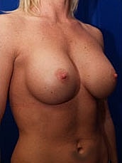 Breast Augmentation Before & After