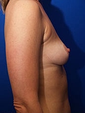 Breast Augmentation Before & After
