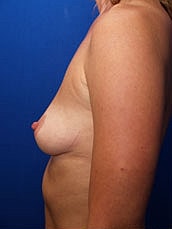 Breast Augmentation Before & After