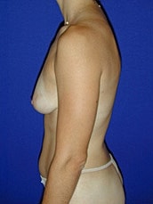 Breast Augmentation Before & After