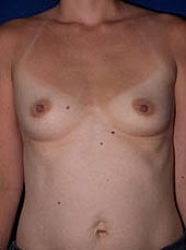 Breast Augmentation Before & After
