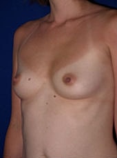 Breast Augmentation Before & After