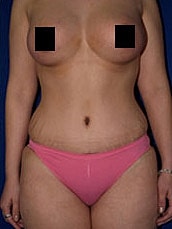 Mommy Makeover Before & After