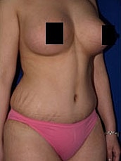 Mommy Makeover Before & After