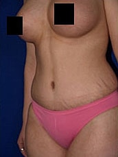 Mommy Makeover Before & After